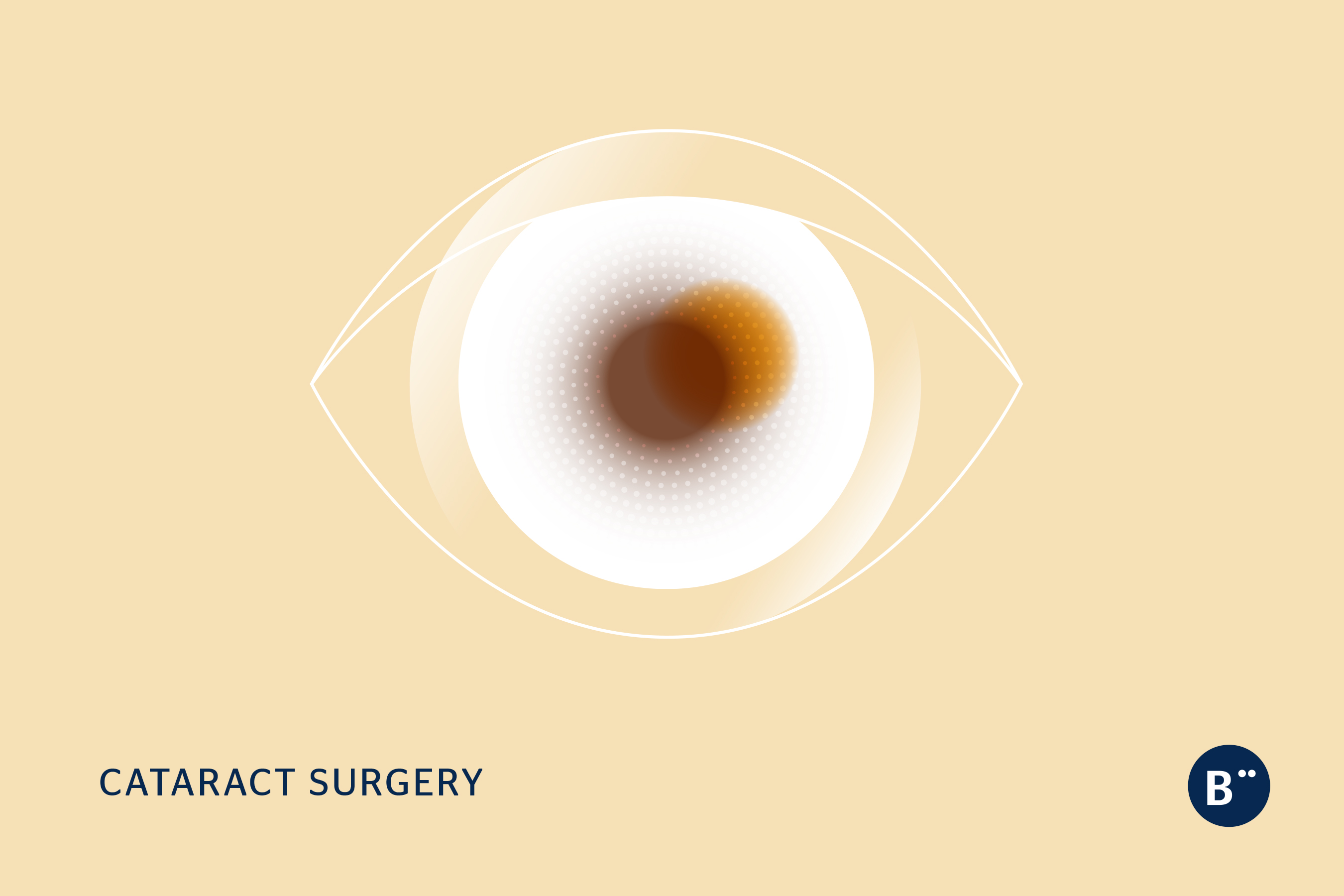 dr_bohm_cataract